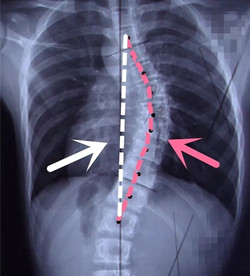 脊柱側(cè)彎后身高會(huì)變短嗎？