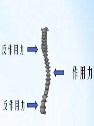 什么是脊柱側(cè)彎矯形器？