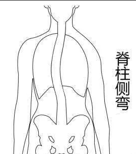 脊柱側(cè)彎康復(fù)訓(xùn)練主要從四個(gè)方面入手！