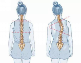 脊柱側(cè)彎的治療方法
